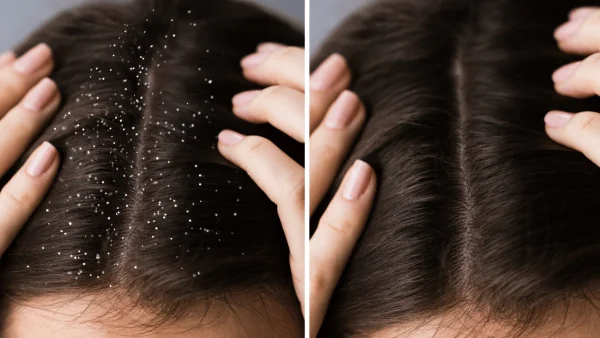 Dandruff vs. Dry Scalp