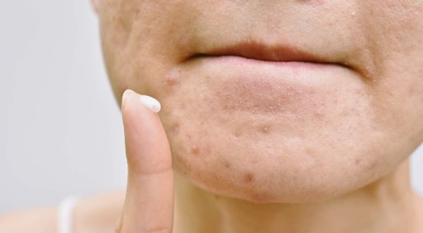 best acne spot treatment