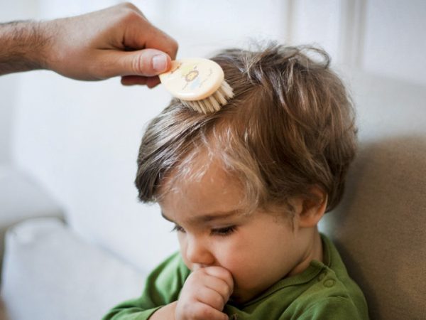 Children with Hair Loss