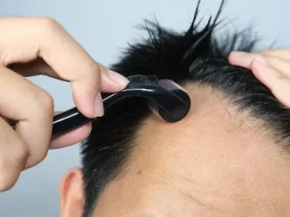 Microneedling for Hair Loss