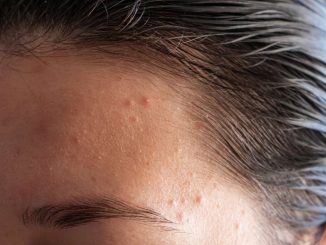 how to get rid of forehead acne