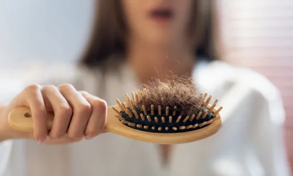 PCOS Hair Loss