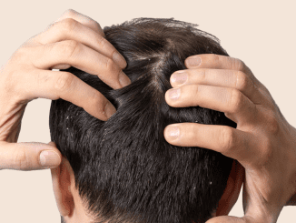 Does Dandruff Cause Hair Loss?