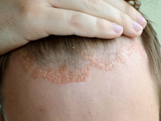 Eczema Shampoo