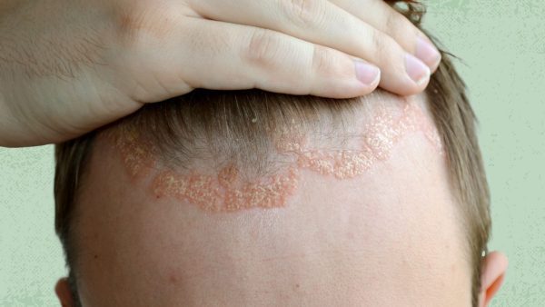 Eczema Shampoo