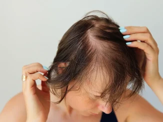 Hair Loss After COVID