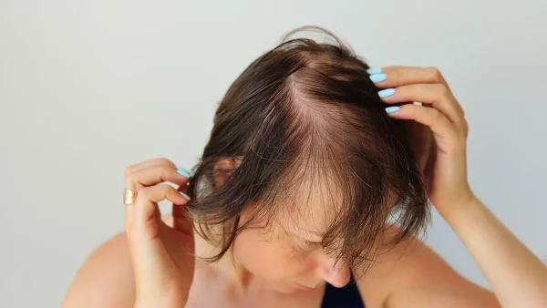 Hair Loss After COVID