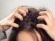 Itchy Scalp and Hair Loss