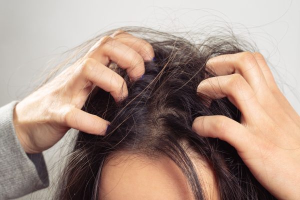 Itchy Scalp and Hair Loss