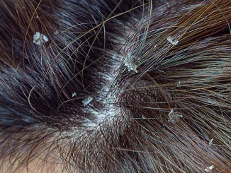 What Does Dandruff Look Like?