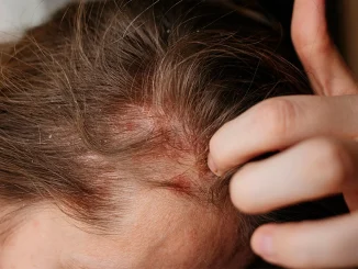 Best Shampoo for Psoriasis