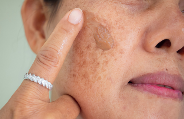how to get rid of dark spots on face