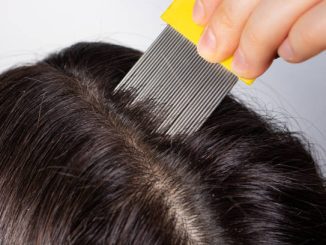 dandruff comb