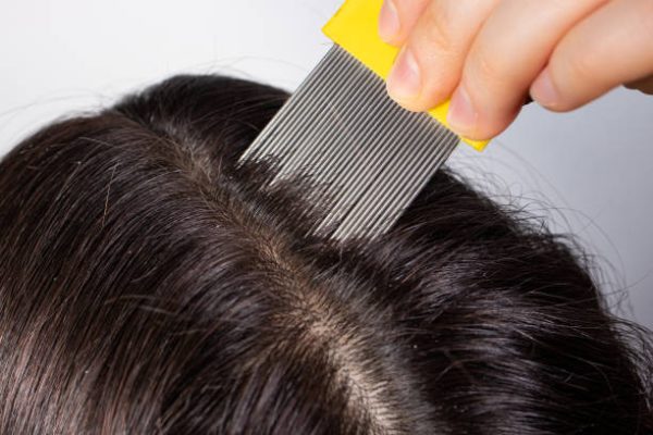 dandruff comb