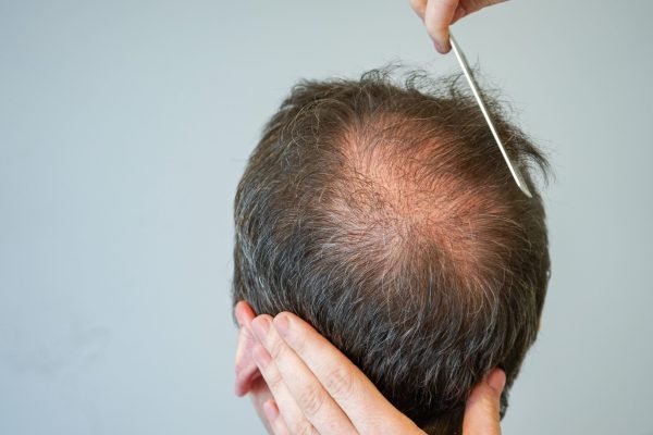 Does Masturbation Cause Hair Loss