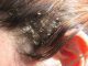 Flaky Scalp Not Dandruff