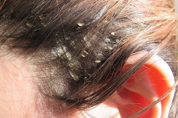 Flaky Scalp Not Dandruff