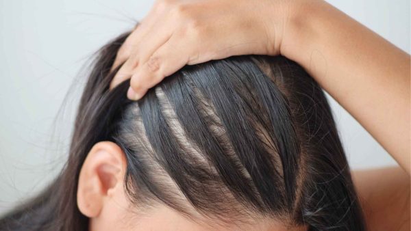  Hair Loss ICD-10
