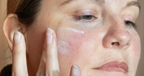 best moisturizer for redness