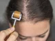 Derma Roller for Hair Growth