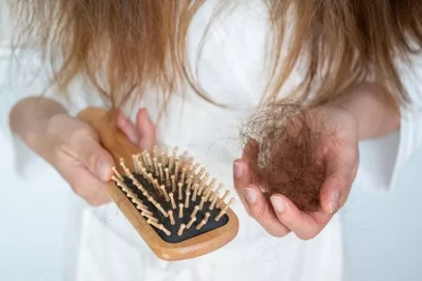 Lupus Hair Loss