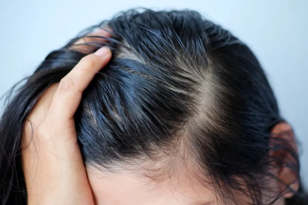 Shampoo for Oily Scalp